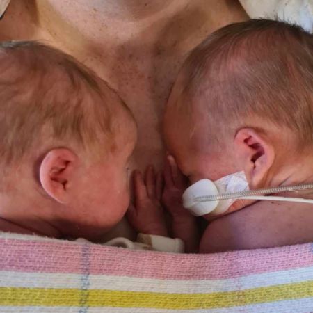 In utero transfusions save baby twins Billie and Poppy